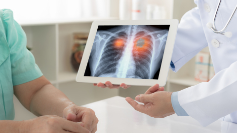 Arzt zeigt Röntgenbild der Lunge mit Lungenkrebs - istockfoto.com/utah778