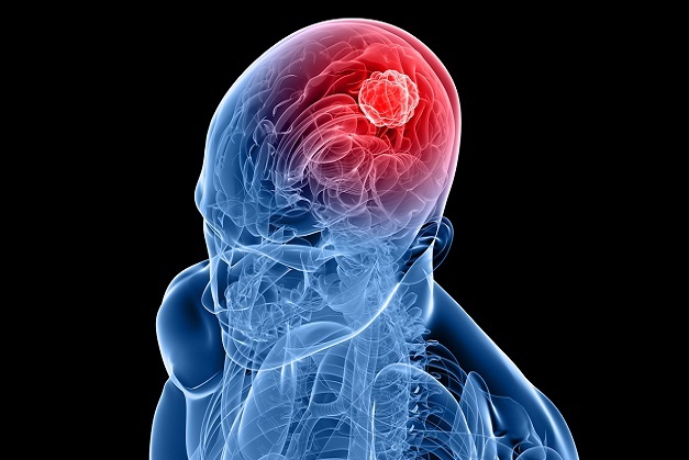 Abbildung Tumor im Kopf